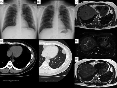Intrathoracic Lipoma Of The Chest Wall That Appeared Relatively Rapidly