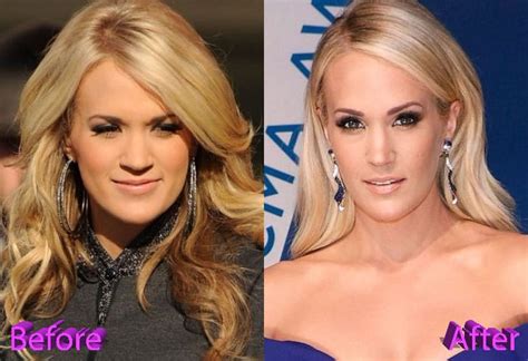 Carrie Underwood Plastic Surgery A Beauty After The Accident