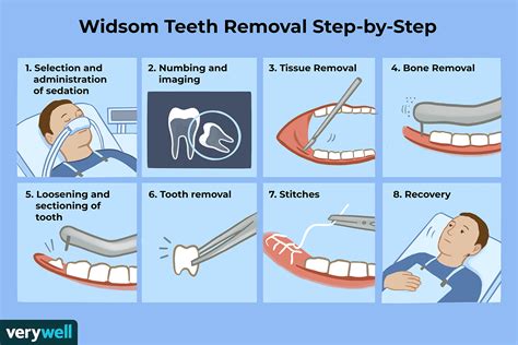 What To Expect When Getting Your Wisdom Teeth Removed 2022