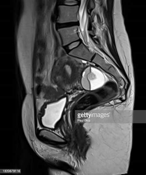 Bone Cyst Photos And Premium High Res Pictures Getty Images