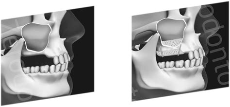 Maxillary Sinus Surgery Lateral Approach The State Of The Art