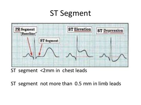 A type ii mimic may result from leads v1 and the shape of the st elevation in leads v1 and v2 in ecg #1 is concave up, which is usually a benign morphology. St segment elevations