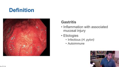 Gastritis Gastritis Síntomas Y Tratamiento ⚡️ Esdoctor