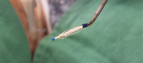 Balloon Offers Lasting Relief From Chronic Eustachian Tube Dysfunction