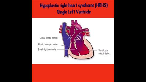 Hypoplastic Right Heart Syndrome Hrhs Single Left Ventricle Youtube