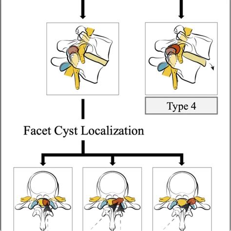 Example Of A Mediolateral Facet Cyst On The Axial Mri Scan A The