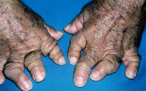 Diagnostic Symptoms Of Psoriatic Arthritis Mims Online