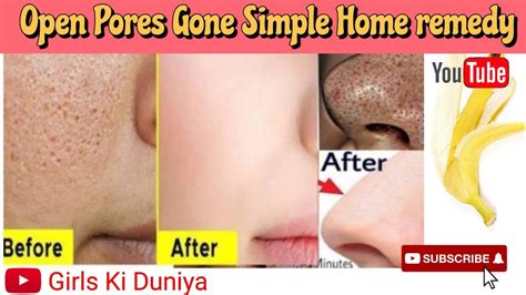 Open Pores Salutation At Home Remedyhow To Shrink Open Pores In One Week Youtube