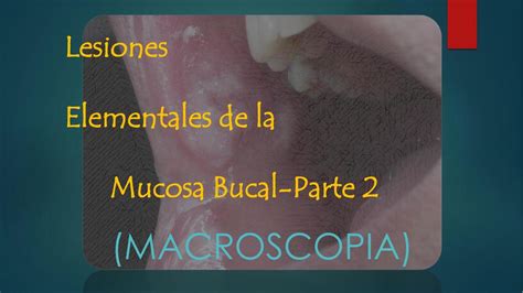 Lesiones Elementales De La Mucosa Bucal Sol Sempertegui Udocz