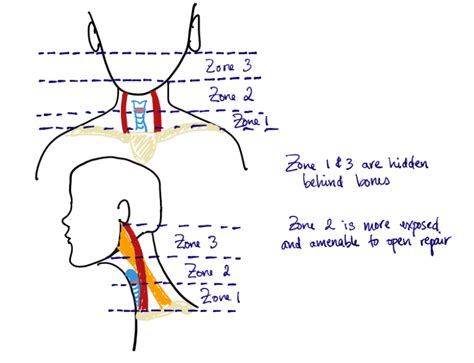 Get In The Zone Penetrating Neck Trauma Part 1 Criticalcarenow