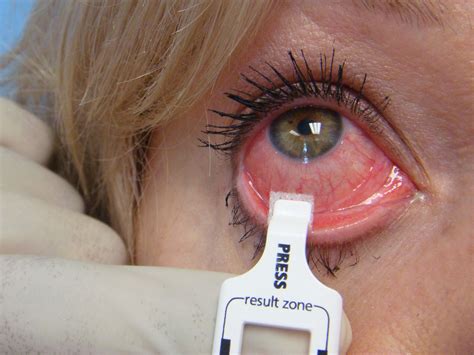 Adenoviruses is the cause of viral conjunctivitis. RPS Releases Statement on 2014 Conjunctivitis Season ...