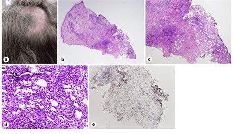 A Clinical Presentation Of The Primary Scalp Lesion B Histology Of The
