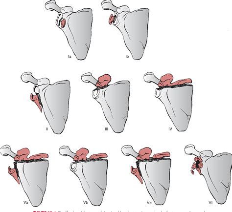 Pdf Glenoid Fractures Scapular Neck Fracture The Superior Shoulder