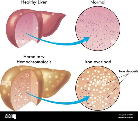 Medical Illustration Shows The Difference Between A Healthy Liver And