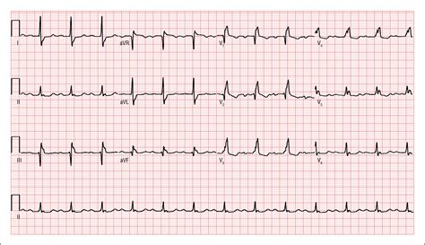 Significance Of First Degree Atrioventricular Block In Acute