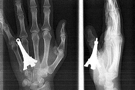 The appropriate body part will be lined up under the xray machine where images will be taken; Amazing X-ray of boy with 15 fingers and 16 toes - Mirror Online