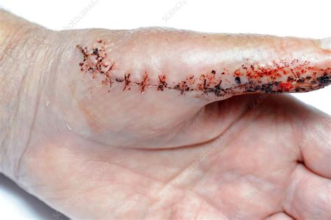 Sutured laceration injury - Stock Image - C019/7562 - Science Photo Library