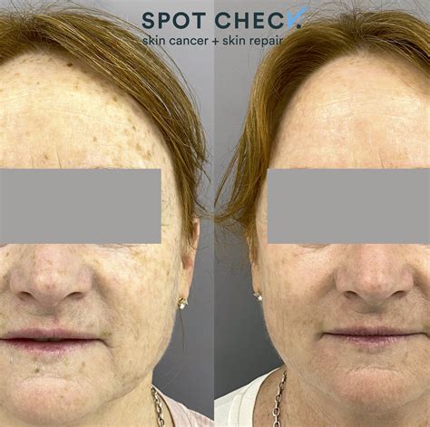 Ipl Skin Rejuvenation Clinic Melbourne Facial And Skin Treatment