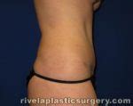 The Woodlands Tummy Tuck Abdominoplasty Before And After Photos