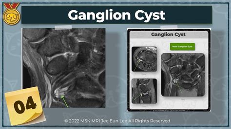 Anatomy04 Ganglion Cystlong Radiolunate Ligament Radioscaphocapitate Ligamentwrist Mri