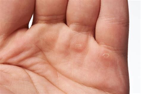 Tips For How To Remove Calluses Naturally From Hands And Dry Feet My
