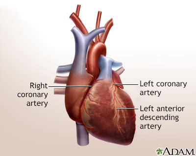 A buildup of plaque can narrow these arteries, decreasing blood flow to your heart. Heart bypass surgery - minimally invasive