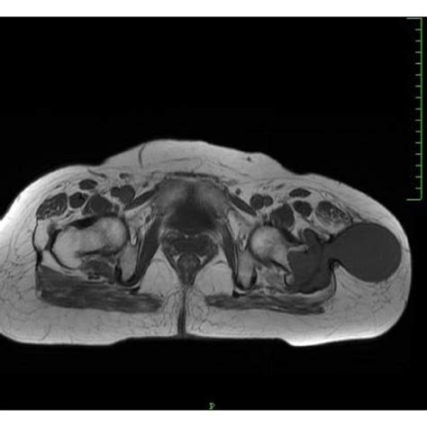 Axial T1 And T2 Weighted Mri Image Of The Pelvis Showing The Abscess