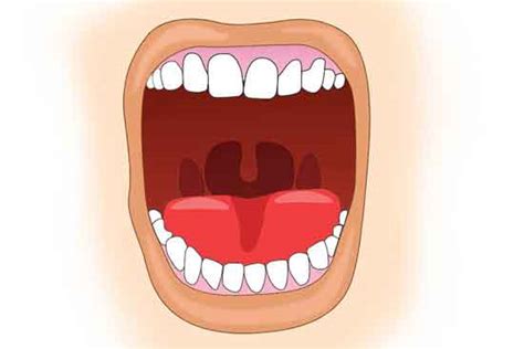 Swollen Uvula Uvulitis Causes Symptoms Treatment Evolving World