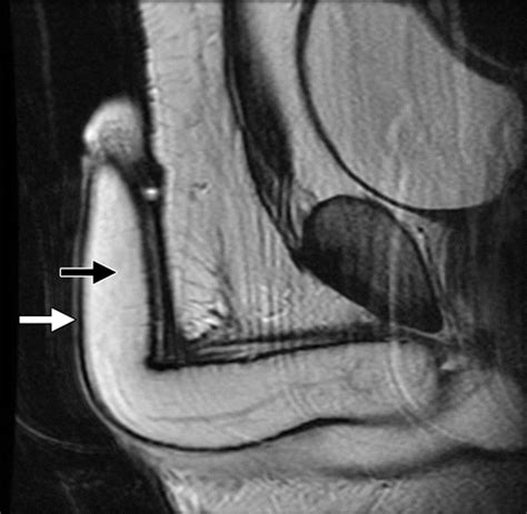 Mr Imaging Of The Penis And Scrotum Radiographics