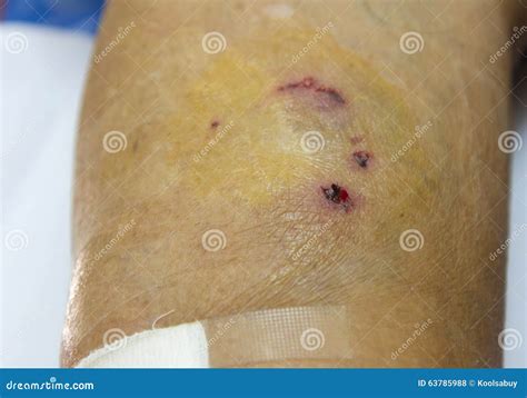 143 Dog Bite Wound Photos Free And Royalty Free Stock Photos From
