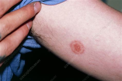 Ringworm Infection Stock Image M2700054 Science Photo Library