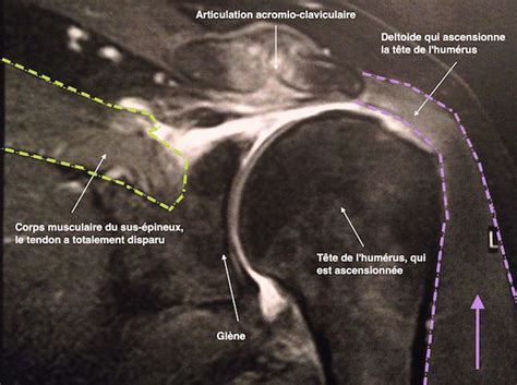 Passage en revue des différents vous avez du mal à bouger votre épaule, votre coude, ou encore votre poignet ? L'arthrose de l'épaule et les prothèses d'épaule, par l ...