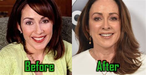 Patricia Heaton Plastic Surgery Botox Boob Job Before After Photos