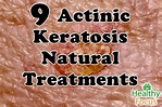 9 Tested Actinic Keratosis Natural Treatments - Healthy Focus