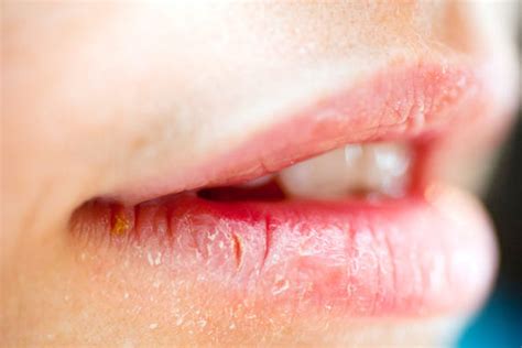 Best Home Remedies For Cracked Lips Corner Or Angular Cheilitis