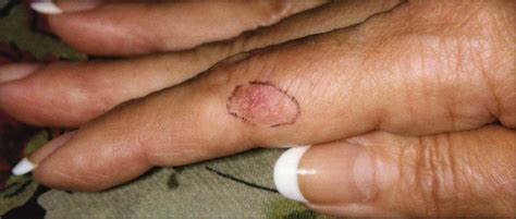 Occurrence Of Nonmelanoma Skin Cancers On The Hands After Uv Nail Light