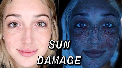 Florida Sun Damage Under Black Light Biopsy For Skin Cancer Youtube