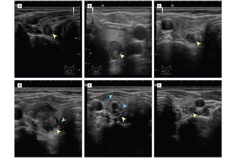 The Diagnosis And Management Of Thyroid Nodules A Review