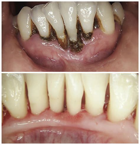 Gingivitis Before And After Treatment