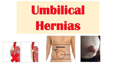 Umbilical Hernia Belly Button Hernia Risk Factors Signs And