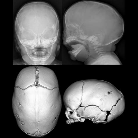 Sagittal Suture Craniosynostosis
