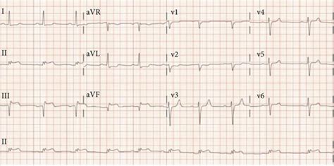 Electrocardiogram Revealing St Elevations In Leads Ii Iii And Avf