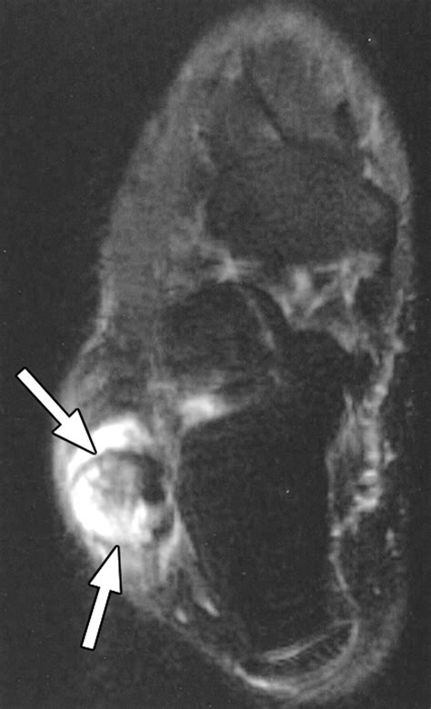 Mri Of An Intratendinous Ganglion Cyst Of The Peroneus Brevis Tendon Ajr