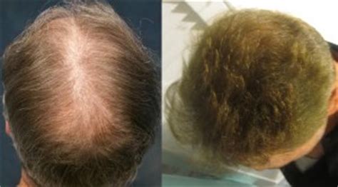 Mens Before And After Hair Transplant Photos