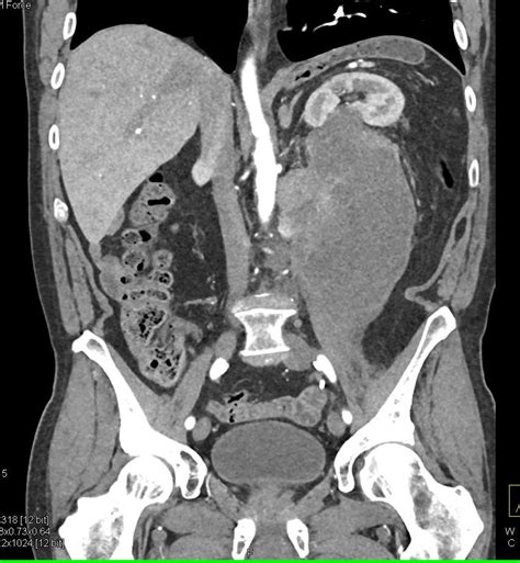 Retroperitoneal Sarcoma Displaces The Left Kidney Kidney Case Studies