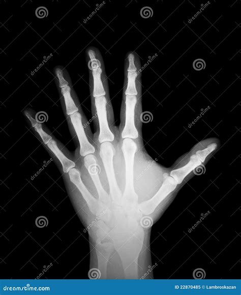 X Ray Of Human Hand Stock Image Image Of Arthritis Anatomy 22870485