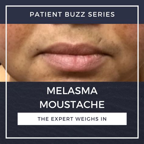 Patient Buzz Melasma Moustache The Expert Weighs In Next Steps In