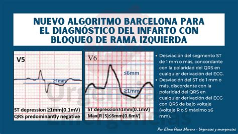 Nuevo Algoritmo Barcelona Para El Diagnóstico Del Infarto Con Bloqueo