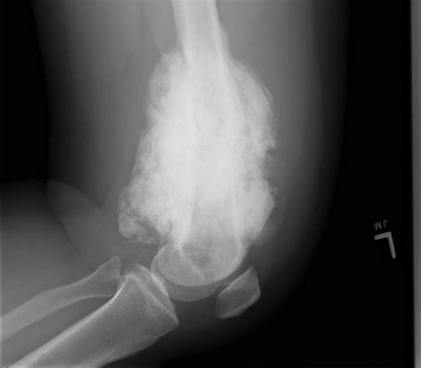 Osteosarcoma