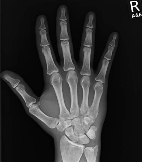 Normal Hand Radiograph Radiology Case